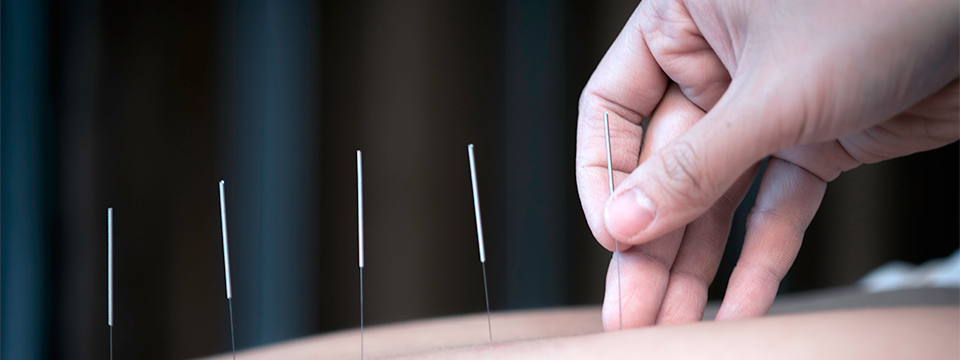 Is Acupuncture The Way Forward For Allergies & Asthma?